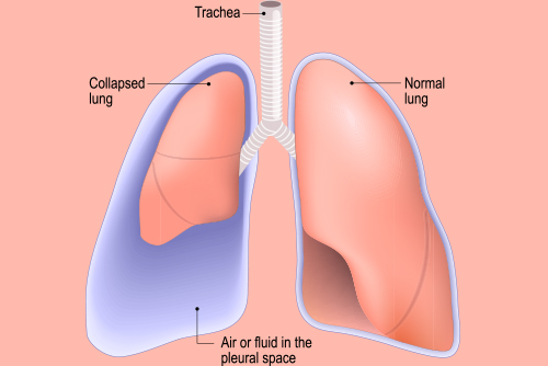 lung cancer.jpg